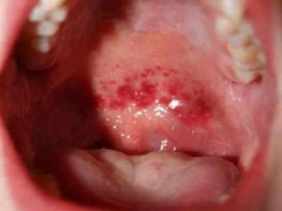 Triệu chứng bệnh lậu ở nữ giới