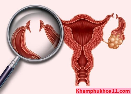 Thắt ống dẫn trứng
