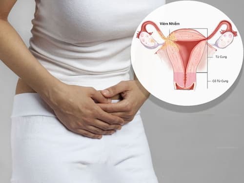 Viêm phần phụ là gì?