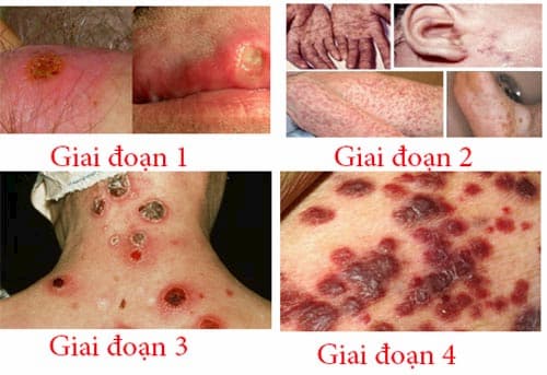 Dấu hiệu bệnh giang mai qua các giai đoạn