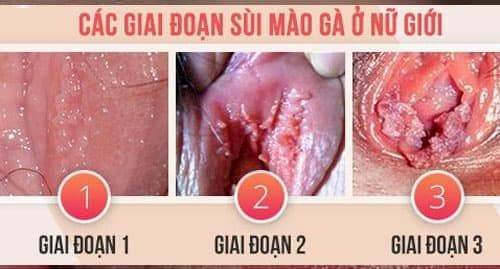 Dấu hiệu sùi mào gà ở nữ