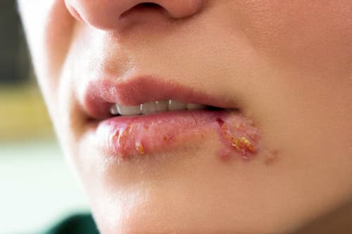 Mụn rộp sinh dục ở môi