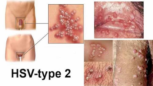 Triệu chứng mụn rộp sinh dục ở nam và nữ
