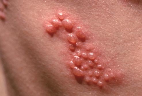 Mụn rộp sinh dục là gì
