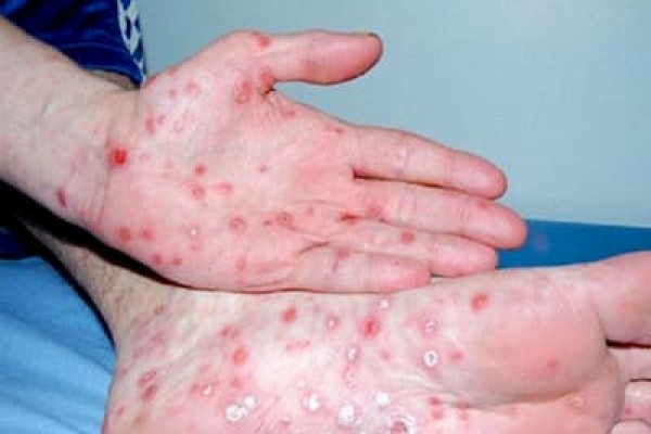 Bệnh giang mai: Nguyên nhân, biểu hiện 5/8/24