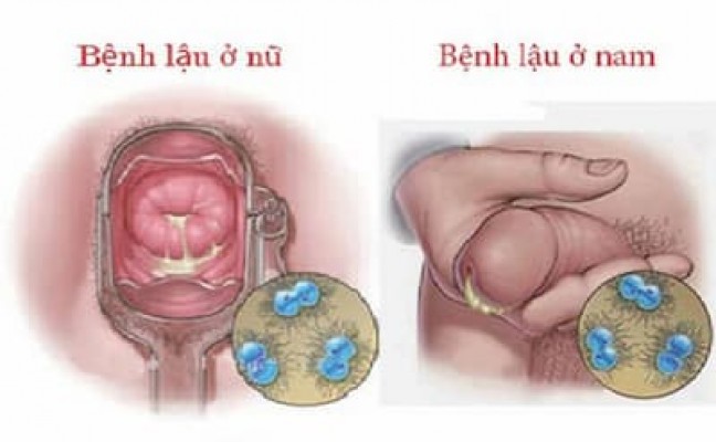 Nguyên nhân triệu trứng và cách chữa bệnh lậu 5/8/24