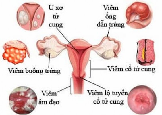 6 ảnh hưởng nguy hiểm của bệnh phụ khoa 5/10/24