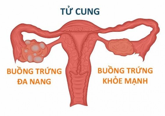 Buồng trứng đa nang: Triệu chứng, nguyên nhân 11/8/23
