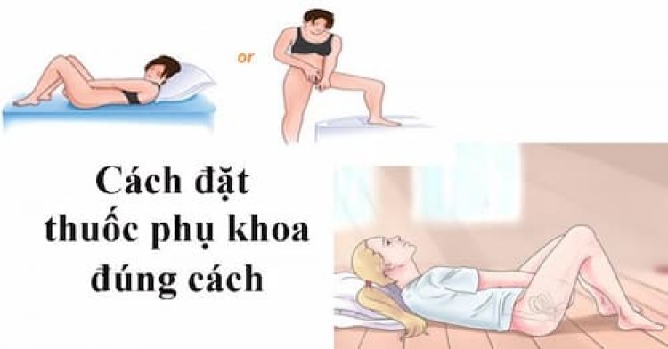 Hướng dẫn cách sử dụng thuốc đặt âm đạo 5/8/24