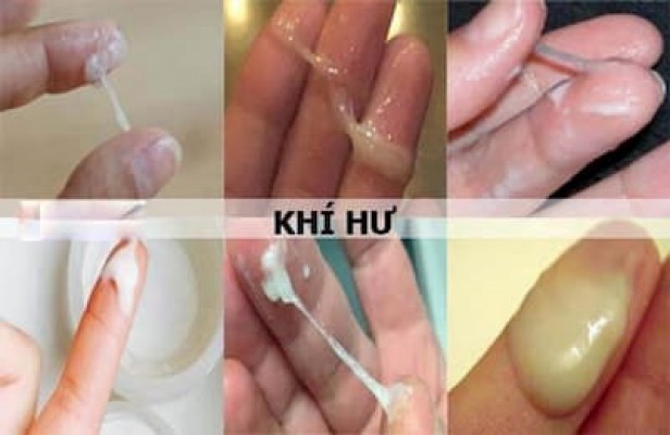 Khí hư bất thường Cảnh Báo bệnh phụ khoa 5/8/24