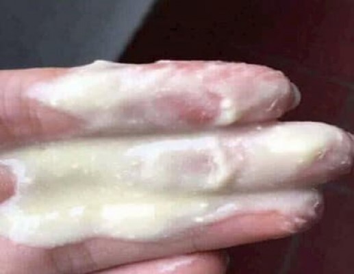 Khí hư ra nhiều có phải mang thai 5/10/24