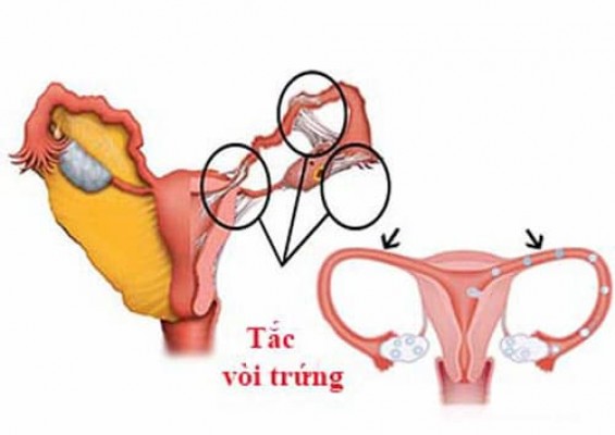 Tìm hiểu nguyên nhân tắc vòi trứng 5/10/24