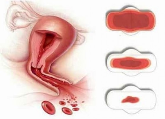 Cách chữa rong kinh hiệu quả 11/8/23
