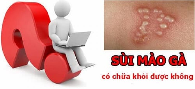Bệnh sùi mào gà có chữa khỏi được không 12/8/23