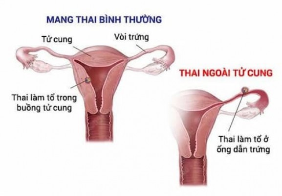 Thai ngoài tử cung phải làm sao? 11/8/23