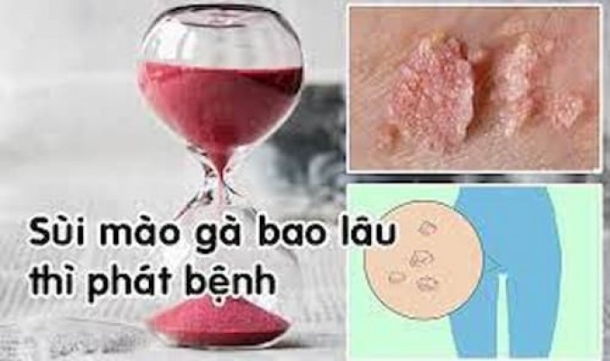 Thời gian ủ bệnh sùi mào gà trong bao lâu 20/7/24
