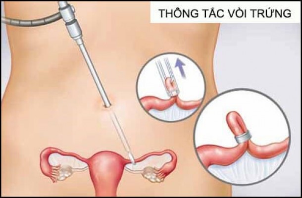 Thông tắc vòi trứng Nguyên nhân 11/8/23