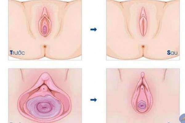 Bí quyết thu nhỏ vùng kín sau sinh 5/8/24