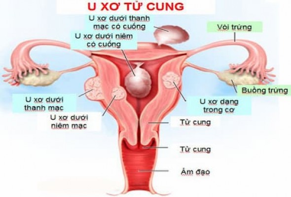 Nguyên nhân gây u xơ tử cung 5/10/24