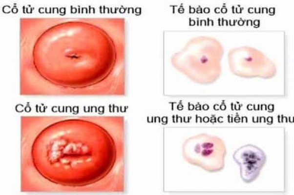 Ung thu cổ tử cung: Nguyên nhân, dấu hiệu, 11/8/23