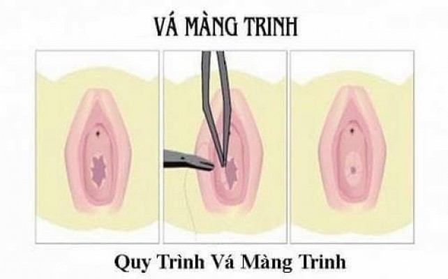 Vá màng trinh - Nên hay không 5/8/24