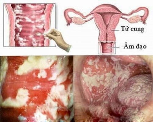 Mẹo chữa viêm âm đạo phổ biến 11/8/23