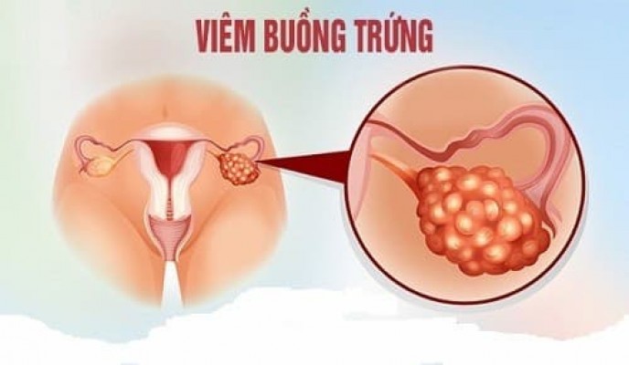 Viêm buồng trứng: Dấu hiệu và cách điều trị 5/10/24