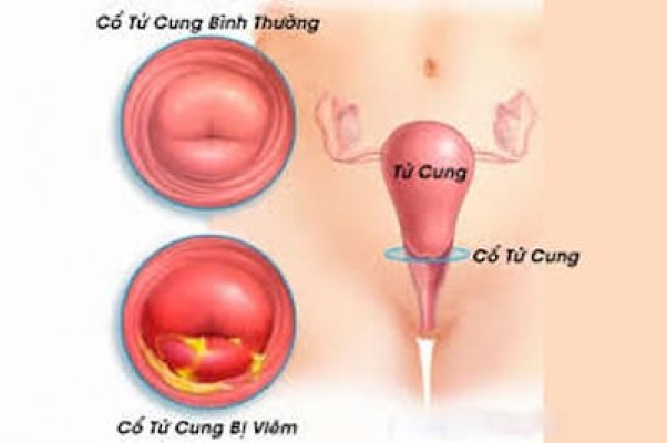 Viêm cổ tử cung khi mang thai nguy hiểm 11/8/23