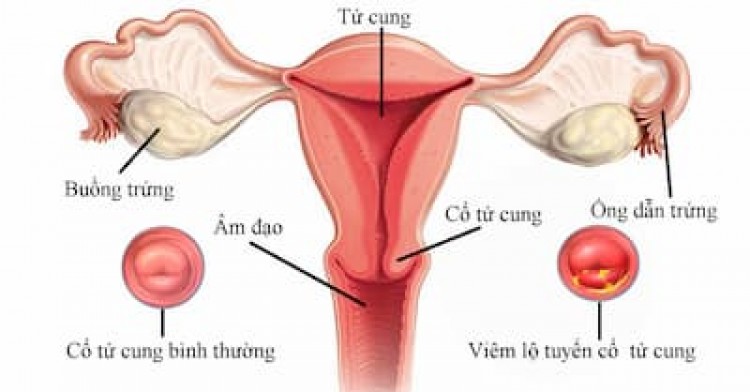 Viêm lộ tuyến cổ tử cung là gì? Biểu hiện và cách điều trị 5/10/24