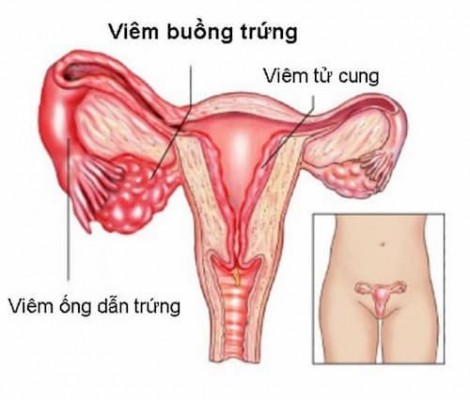 Viêm ống dẫn trứng: Nguyên nhân, Triệu chứng 11/8/23