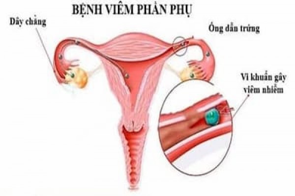 Viêm phần phụ - Nguyên nhân, Triệu chứng 11/8/23
