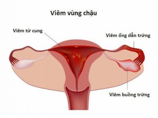 Thuốc điều trị viêm vùng chậu 5/8/24