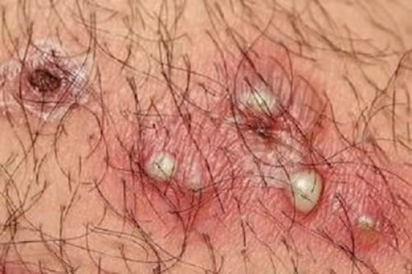 Vùng kín nổi mụn nhưng không đau 11/8/23