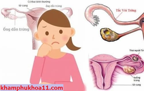 Dấu hiệu tắc vòi trứng