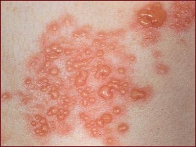 Mụn rộp sinh học