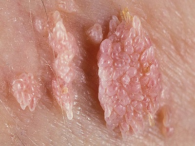 Nguyên nhân gây bệnh sùi mào gà