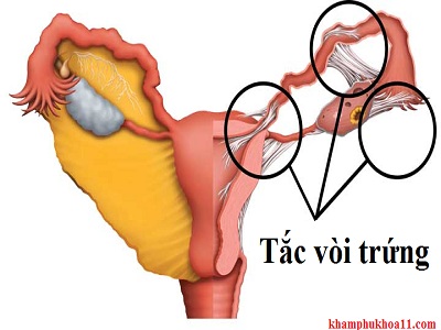 Nguyên nhân tắc vòi trứng