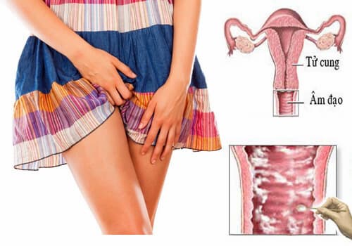 Triệu chứng bệnh phụ khoa