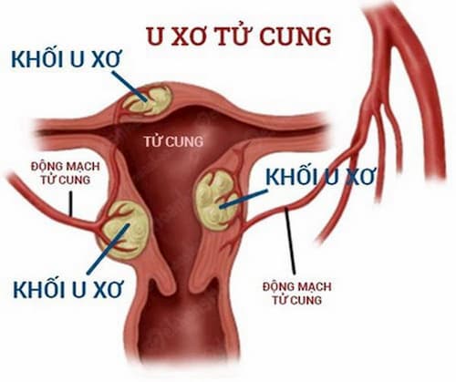 U xơ tử cung là gì?