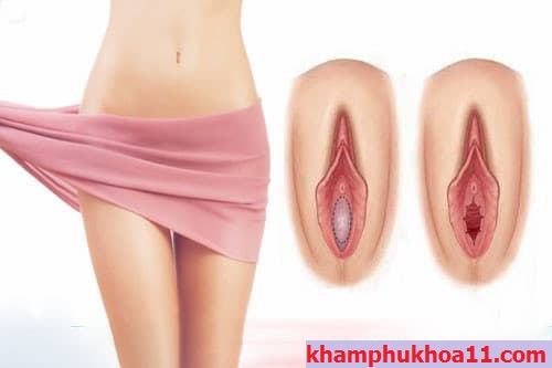 Vá màng trinh là gì?