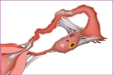 Thông tắc vòi trứng, ống dẫn trứng