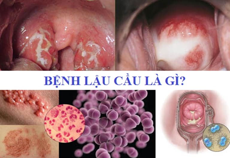 Bệnh lậu là gì?