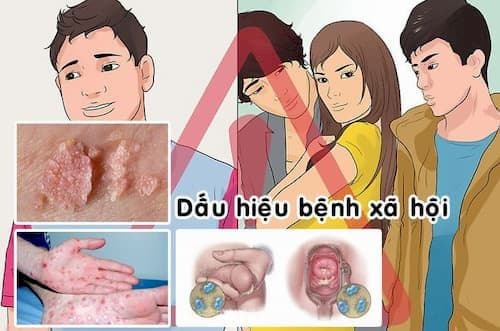 Bệnh xã hội là gì?
