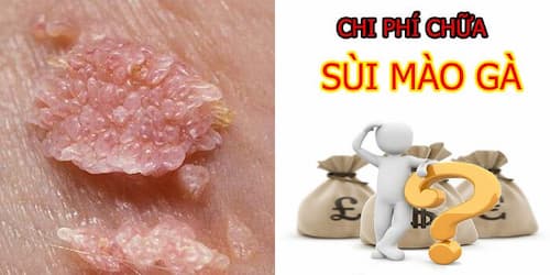 Chi phí chữa bệnh sùi mào gà