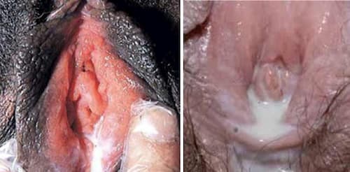 Dấu hiệu bệnh lậu ở nữ giới