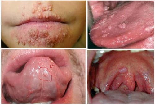 Hình ảnh bệnh sùi mào gà