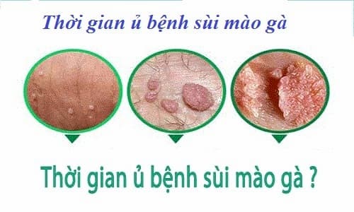 Thời gian ủ bệnh của sùi mào gà